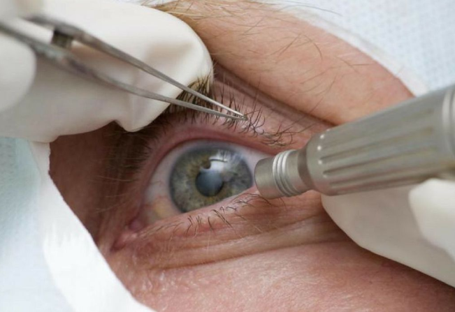 DHS encaminha 172 pacientes para cirurgias oftalmológicas